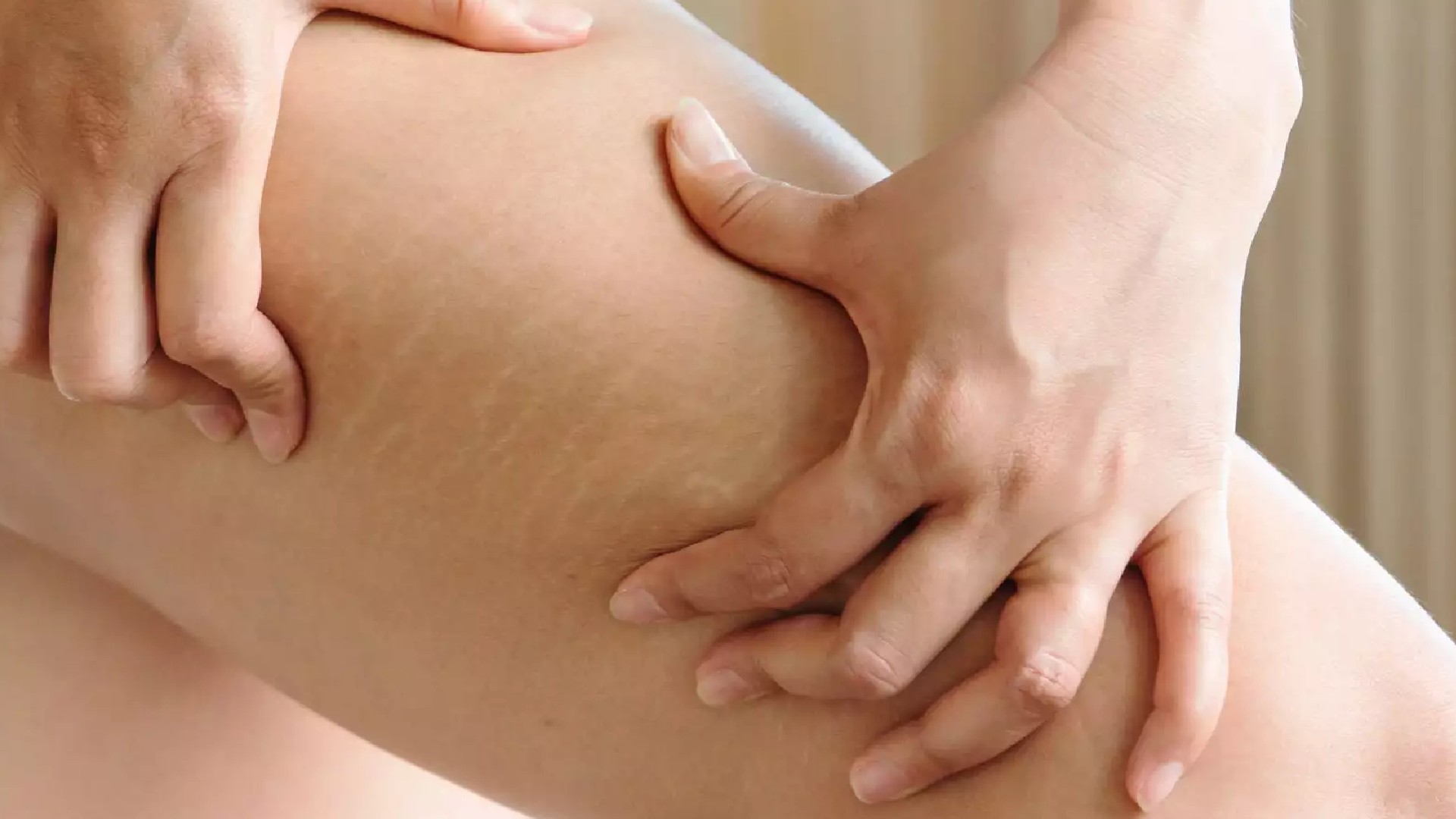 Top 10 Lotions For Stretch Marks